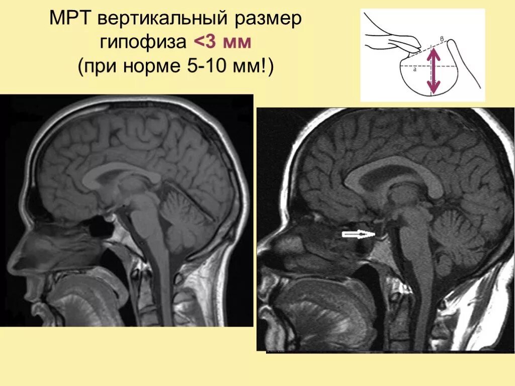 Размер гипофиза. Аденома гипофиза кт. Гипофиз и турецкое седло на мрт. Мрт турецкого седла. Нормальный гипофиз на мрт.