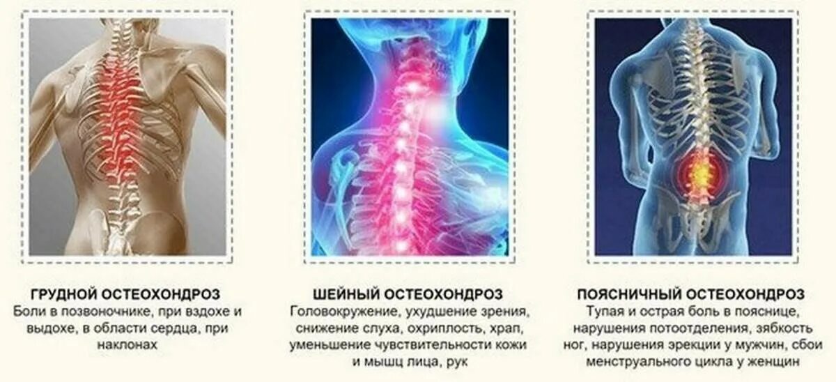 Остеохондроз среднегрудного отдела позвоночника. Шейный остеохондроз. Грудной и поясничный остеохондроз.