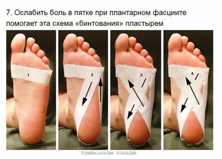 Тейпирование при фасциите