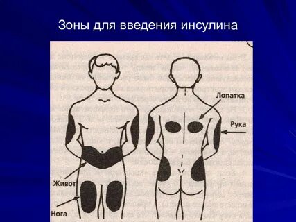 Места введения инсулина