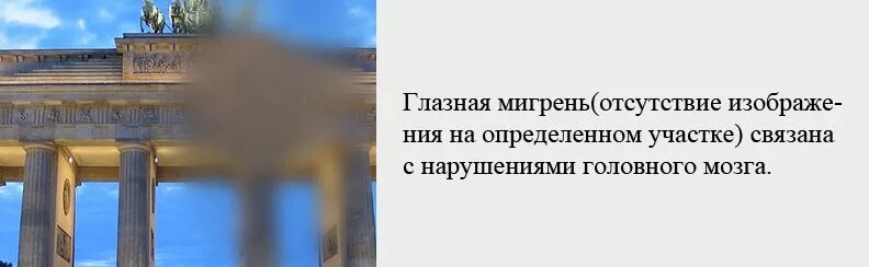 Глазная мигрень. Офтальмологическая мигрень. Окулярная мигрень. Глазная мигрень Мерцательная скотома.