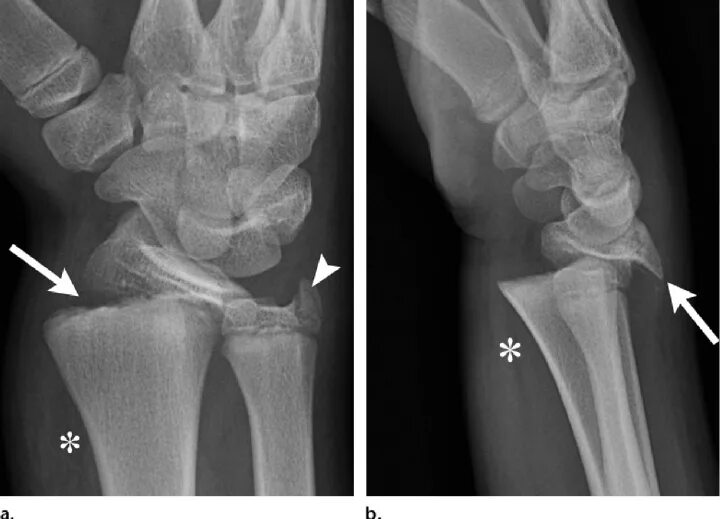 Radius fracture
