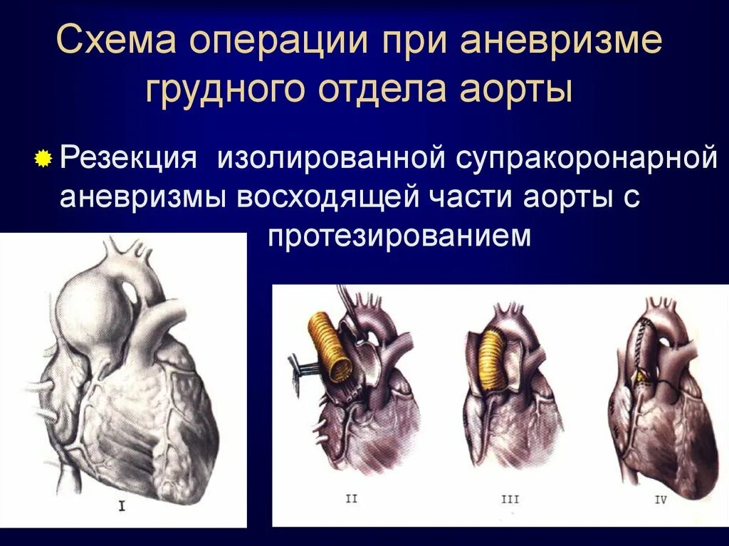 Аневризма аорты какие операции. Операции при аневризме восходящего отдела аорты.