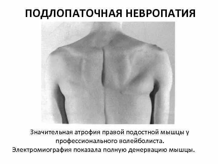 Подлопаточная невропатия. Гипотрофия надостной мышцы. Атрофия мышц плечевого пояса.