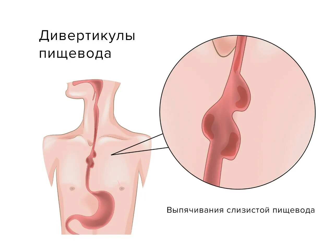 Пищевод жжение лечение