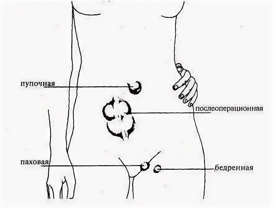 Болит и тянет в паху. Болит в паху слева у женщин. боль в левом паху у женщины. болит в паху справа у женщин.