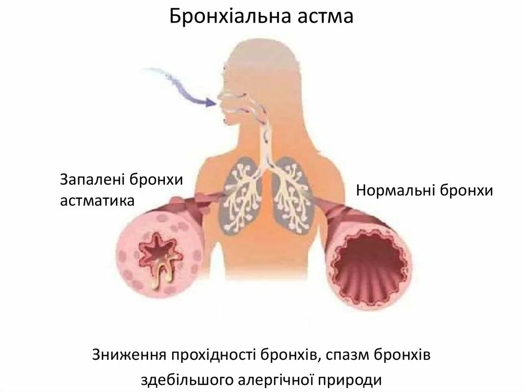 Бронхит нужны для. Бронхи больного бронхиальной астмой. Болезнь бронхиальная астма. Бронхиальная астма картинки. Астма легкие.