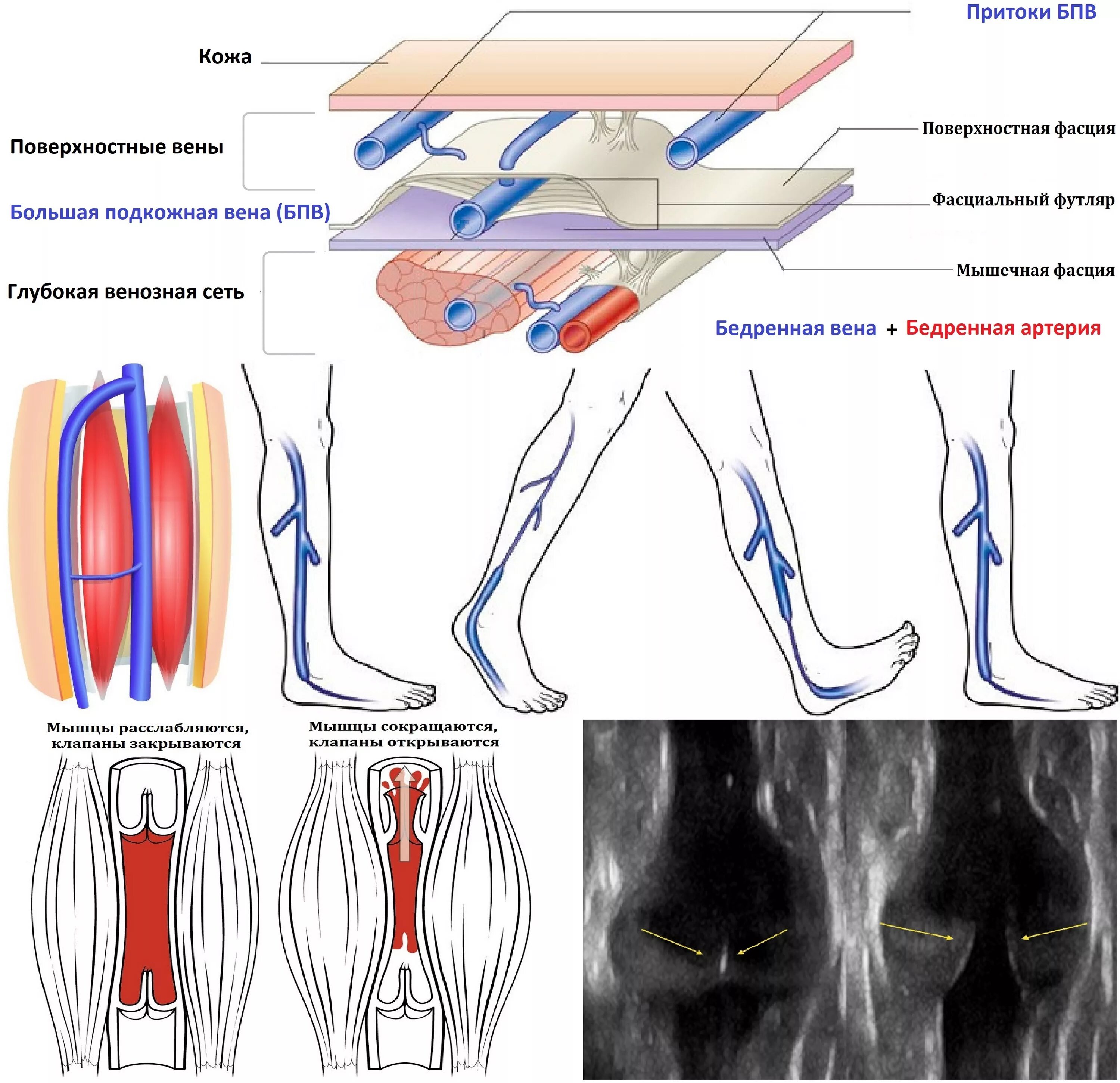 Система поверхностных вен нижних конечностей. Тромбоз вен нижних конечностей схема. Вены нижних конечностей УЗИ анатомия. Перфорантные вены нижних конечностей анатомия. Тромбоз бпв