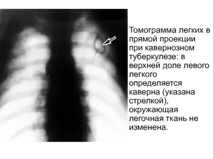 Очаг в верхней доле левого легкого