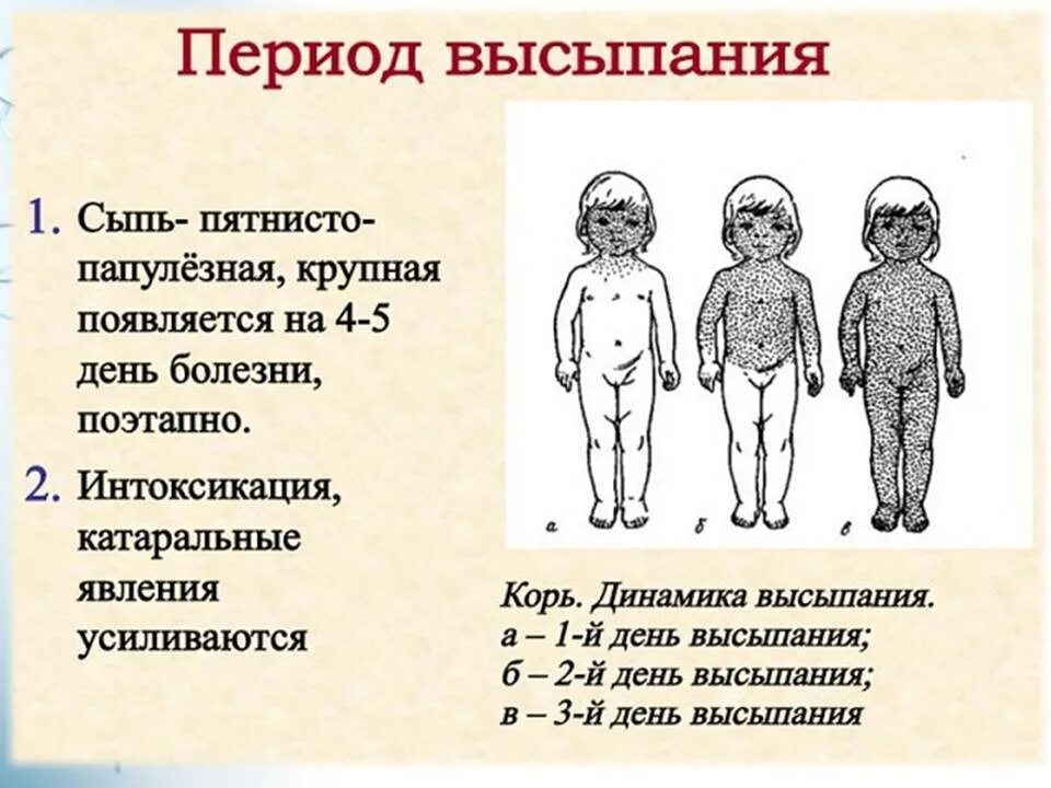 Корь симптомы у детей лечение инкубационный. Этапность сыпи корь краснуха. Признак характерный для сыпи при кори. Этапы возникновения сыпи при кори. Этапность высыпаний при кори.