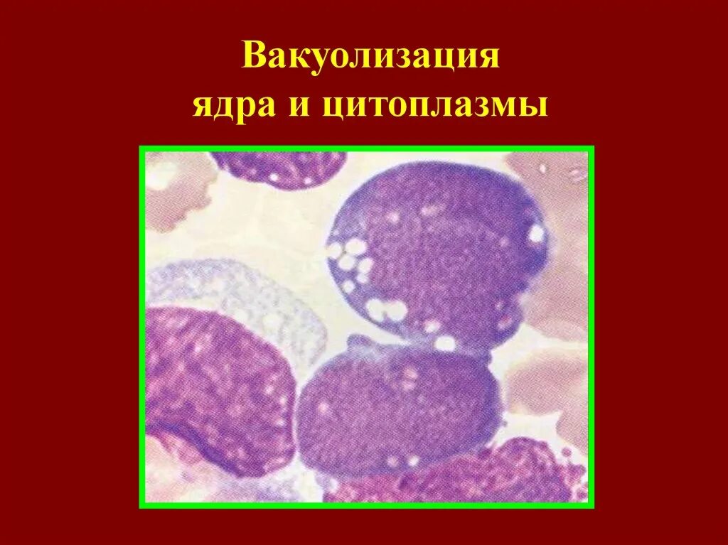 Вакуолизация цитоплазмы нейтрофилов. Вакуолизация ядер нейтрофилов. Вакуолизация цитоплазмы моноцитов. Вакуолизация лейкоцитов. Патология лейкоцитов