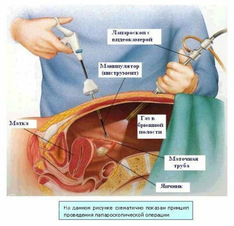 Лапароскопия через сколько можно беременеть. Лапароскопия экстирпация матки. лапароскопия маточных труб. внематочная беременность лапароскопия.