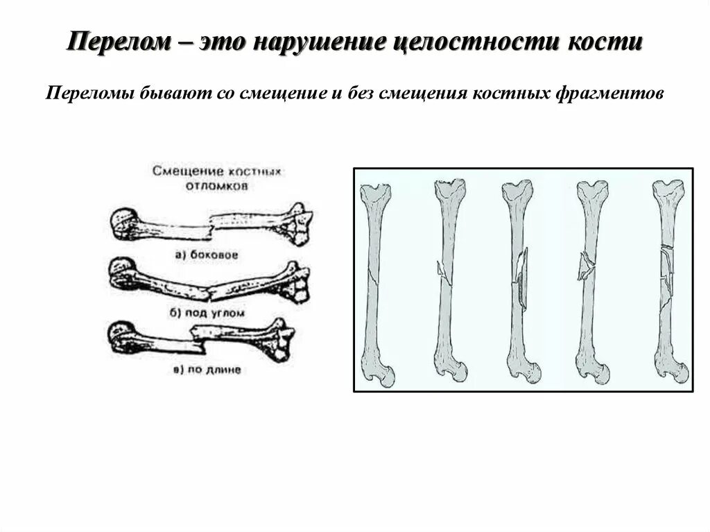 Перелом кости может быть каким. Комбинированный перелом. Боковое смещение костных отломков.