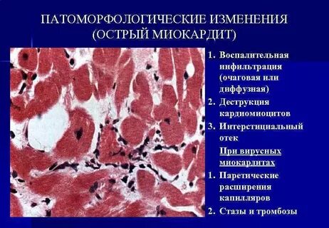 Воспалительная инфильтрация это