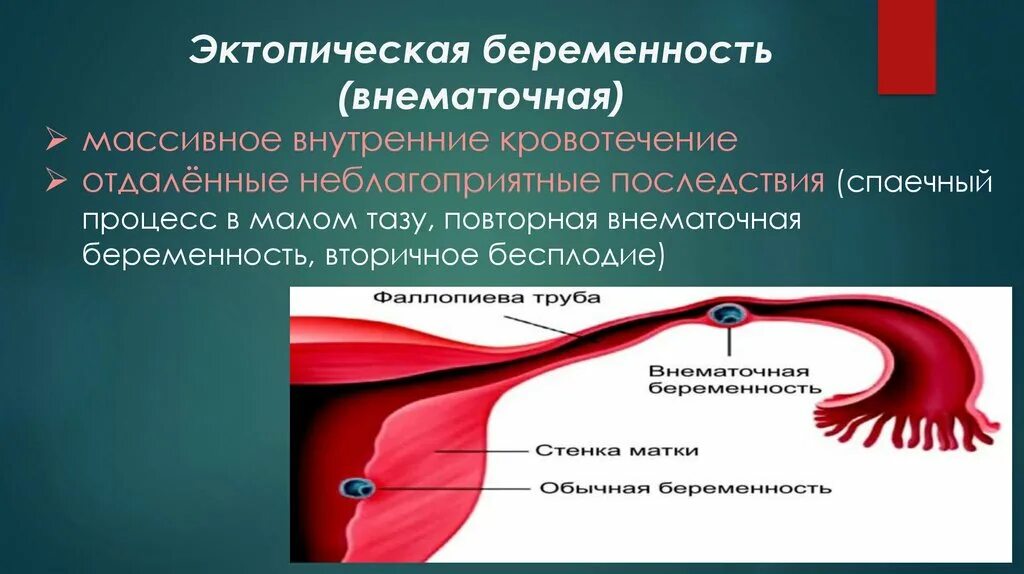 После выскабливания идет кровь. Внематочная беременность. Внематочное кровотечение. Сгустки после окситоцина. Кровотечение во время беременности.