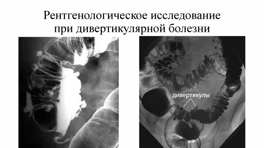 Хронические осложнения дивертикулярной болезни. Осложнения дивертикула. Хронические осложнения дивертикулярной болезни. Дивертикулярная болезнь патогенез. Классификация дивертикулярной болезни кишечника.
