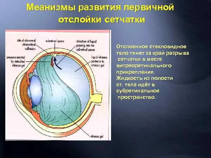 Стекловидное тело и сетчатка. Места прикрепления сетчатки. Стекловидное глазное тело. Задняя отслойка стекловидного тела глаза. Жидкость в сетчатке