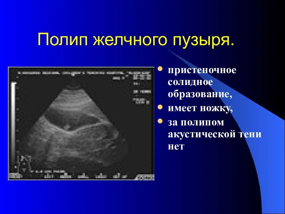 Лечение полипов в желчном пузыре народными средствами. Полпа желчного пузыря?. Полипы в желудочном музыре.