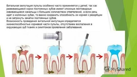 Для удаления коронковой пульпы в молярах используют