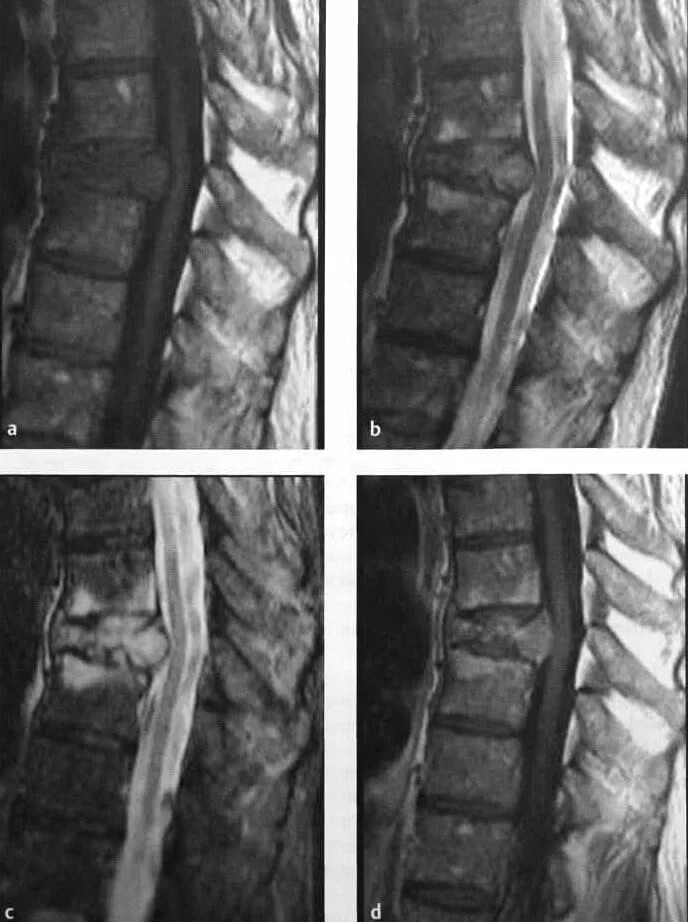 Перелом грудного отдела позвоночника. Компрессионный перелом позвонков мрт. Компрессионный перелом позвоночника т11. Компрессионный перелом позвонка мрт.