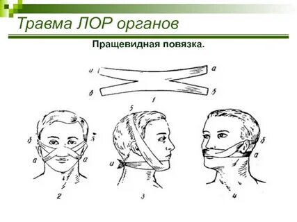 Пращевидная повязка