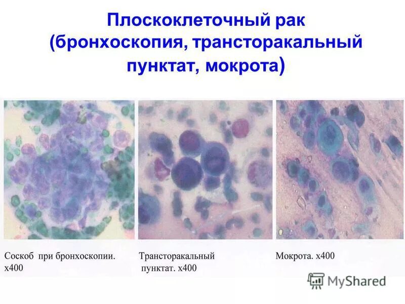 Плоскоклеточная карцинома цитология. Карцинома (плоскоклеточный рак). Ороговевающий плоскоклеточный РВК кожи. Плоскоклеточная карцинома гистология. Стадии рака легких плоскоклеточный