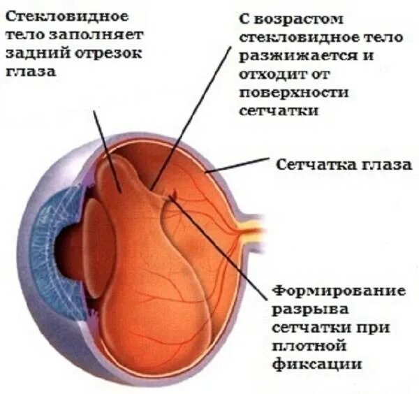 Микроразрывы сетчатки. Периферический разрыв сетчатки.