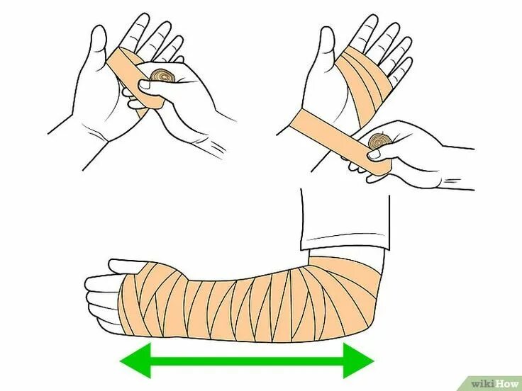 Перевязка самостоятельно. Бинтование запястья эластичным бинтом. Перевязка руки эластичным бинтом. Перебинтовать кисть эластичным бинтом. Перебинтовать кисть руки бинтом.