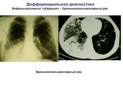 Признаки инфильтративных изменений в легких что
