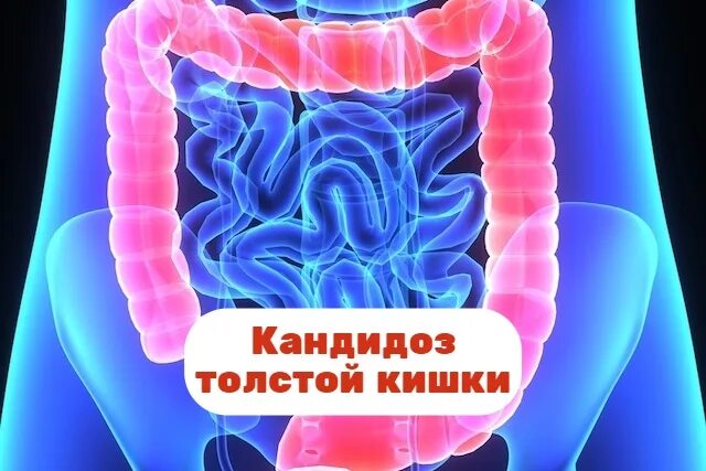 Кандидоз кишечника симптомы и лечение у взрослых. Толстый кишечник метеоризм. дивертикулёз толстой кишки симптомы. интерпозиция толстой кишки.