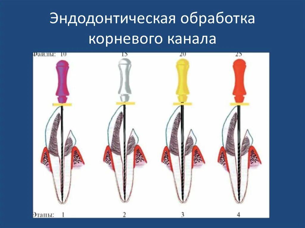 Стандартная техника расширения корневого канала. Обработка корневых каналов. Инструментальная обработка корневых каналов. Инструментальная обработка канала зуба. Препарирование корневого канала