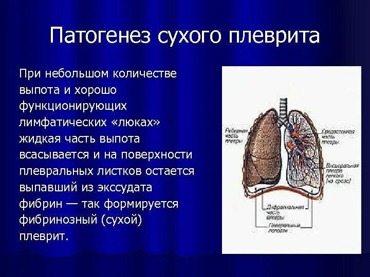 Плевральные осложнения. Фибринозный сухой плеврит патогенез. Патогенез сухого плеврита. Плевральный выпад и плеврит. Фибринозный плеврит патогенез.