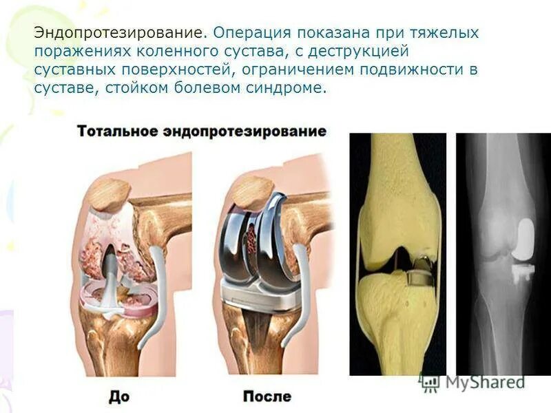 Деформирующий гонартроз коленного сустава. Деформирующий артроз 1-2 степени. Деформирующий артрит коленного сустава. Деформирующий остеоартроз 1 степени коленного. Что разрушает суставы