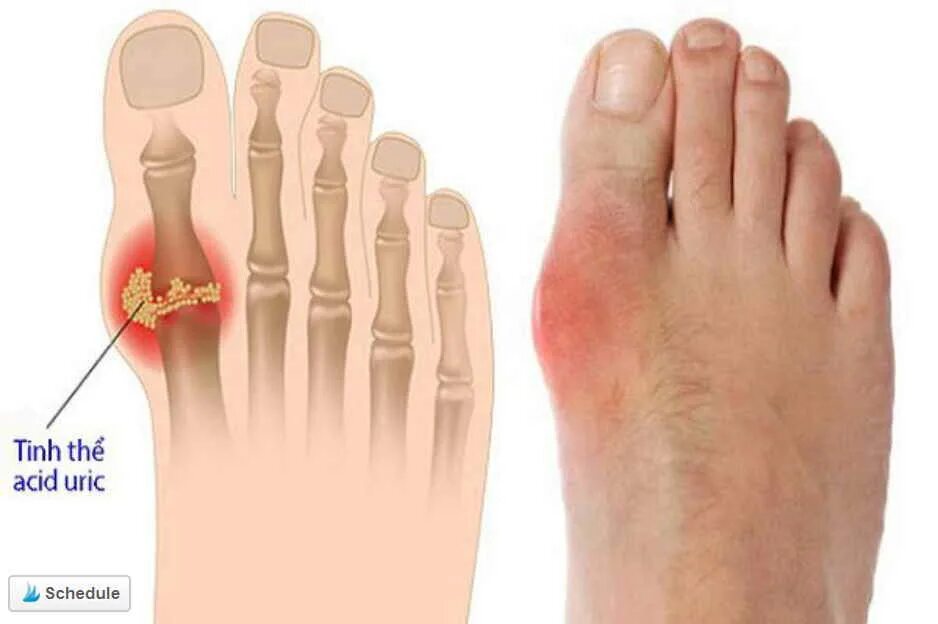 кость на стопе сбоку от большого пальца. болит большой палец на ноге. болит сустав большого пальца на ноге. вальгус болит косточка. болит большой палец на ноге.