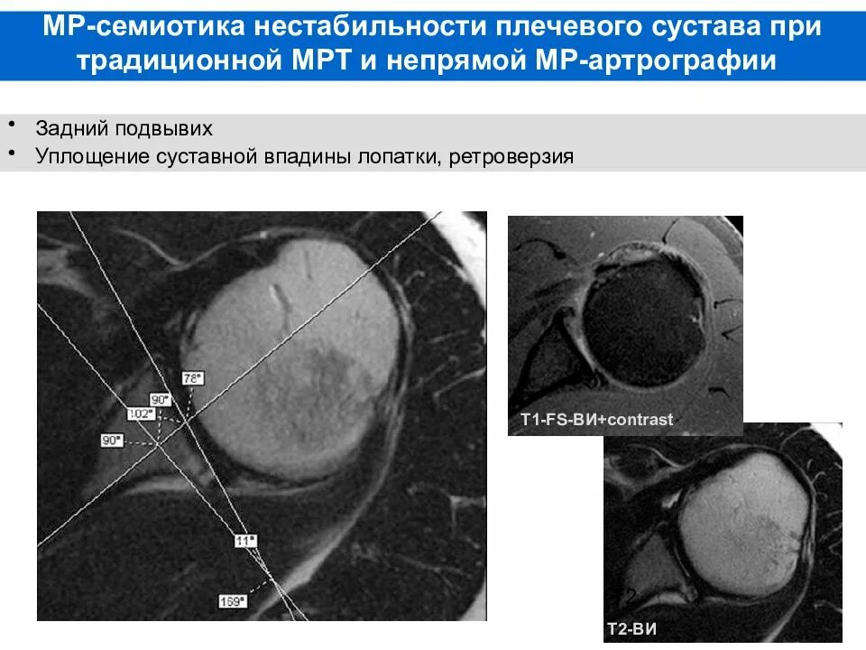 Нестабильность плечевого сустава мкб. Нестабильность плечевого сустава мрт. передняя нестабильность плечевого сустава мрт. признаки нестабильность плечевого сустава. перелом плечевого сустава мрт.