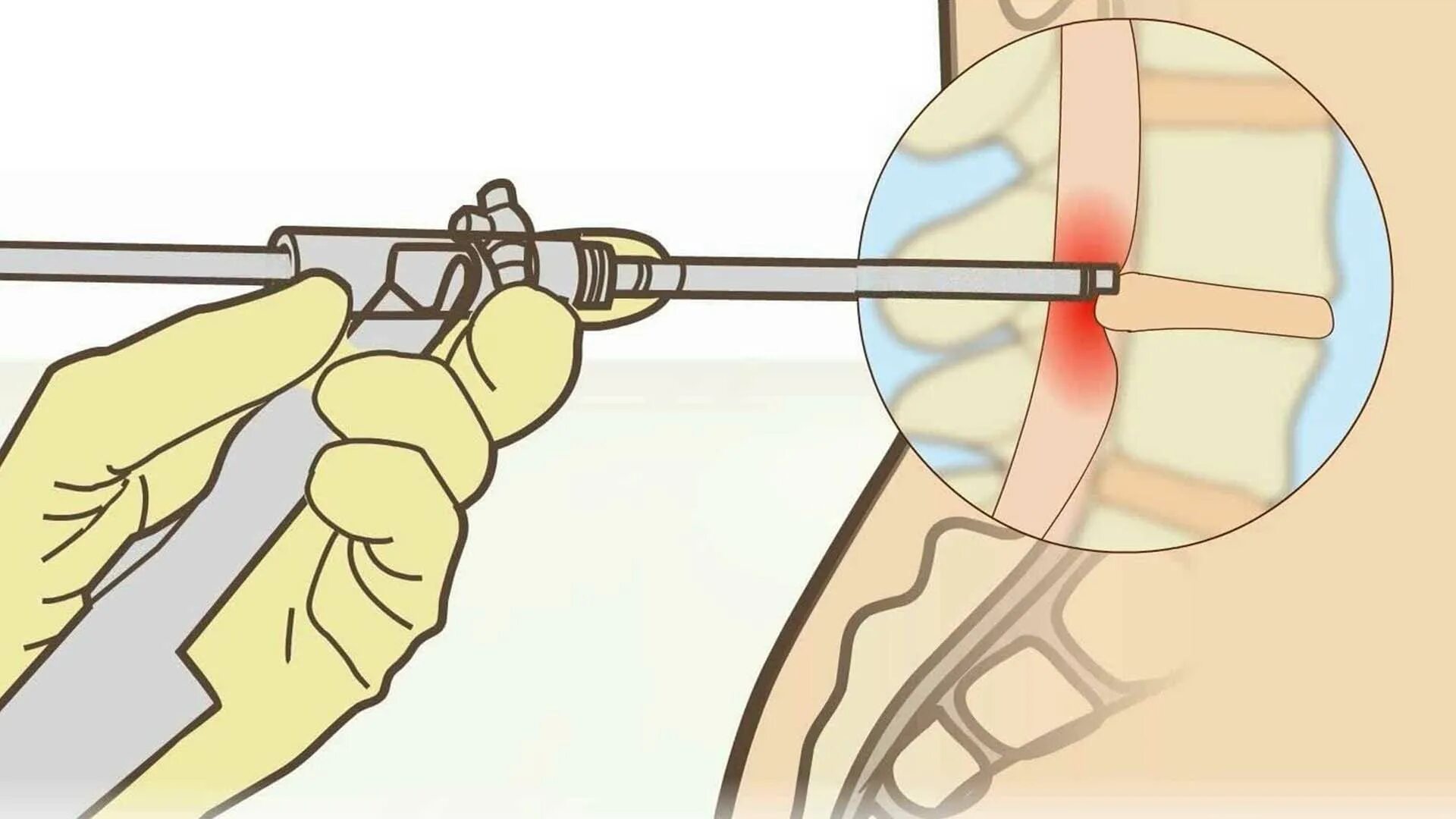 Операция лазером на позвоночнике грыжа. Лазерная вапоризация грыжи позвоночника. Лазерная вапоризация грыжи межпозвоночного диска. Блокада грыжа межпозвоночного диска.