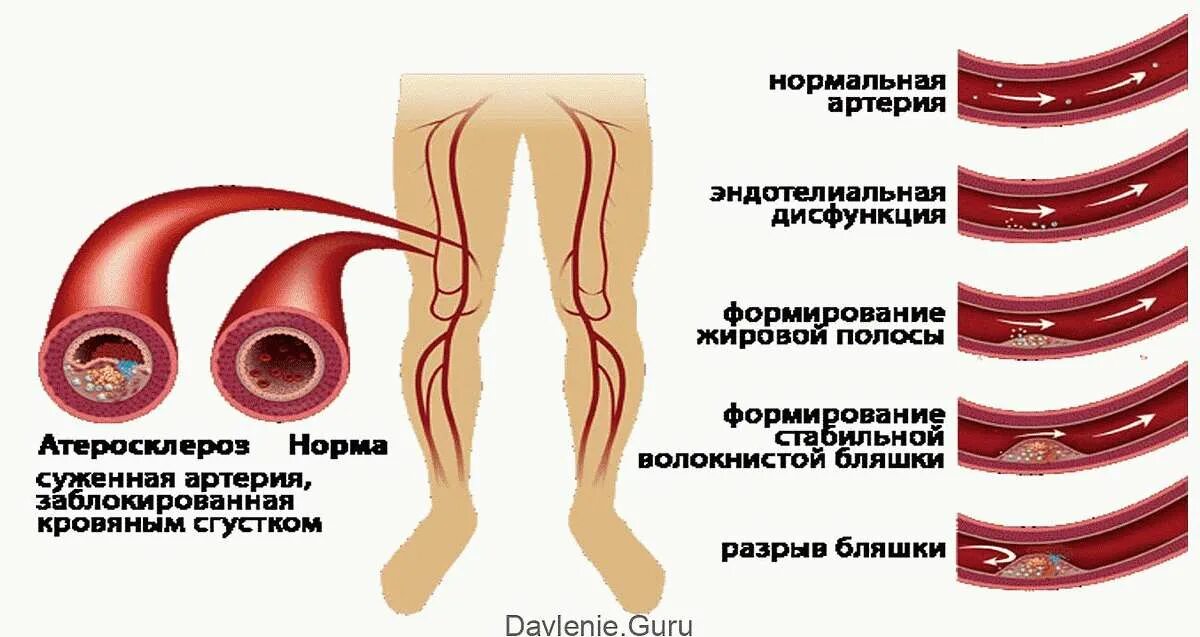 Атеросклеротическое поражение нижних конечностей