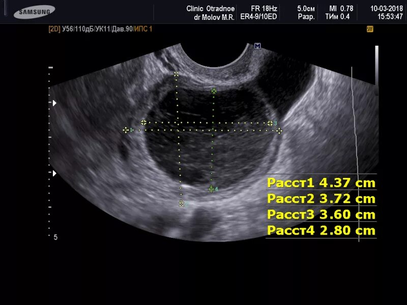 Киста внутри яичника на УЗИ. Киста размеры для операции