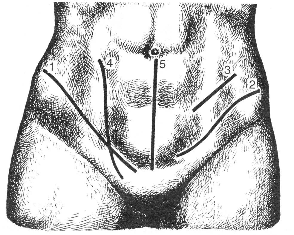 Паховая складка у мужчин. Разрез Федорова лапаротомия. Разрезы Федорова Бергмана Израэля. Внебрюшинный разрез Пирогова.