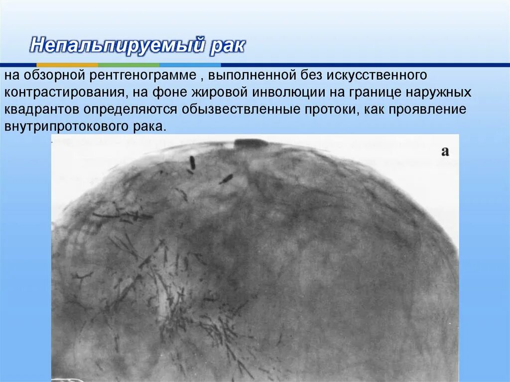 Фиброзный тип инволюции