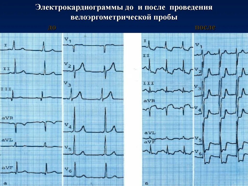 St ишемия. Ишемия миокарда на ЭКГ. ЭКГ при хронической ишемической болезни сердца. Расшифровка ЭКГ ишемия миокарда. ЭКГ при ишемии передней стенки миокарда.