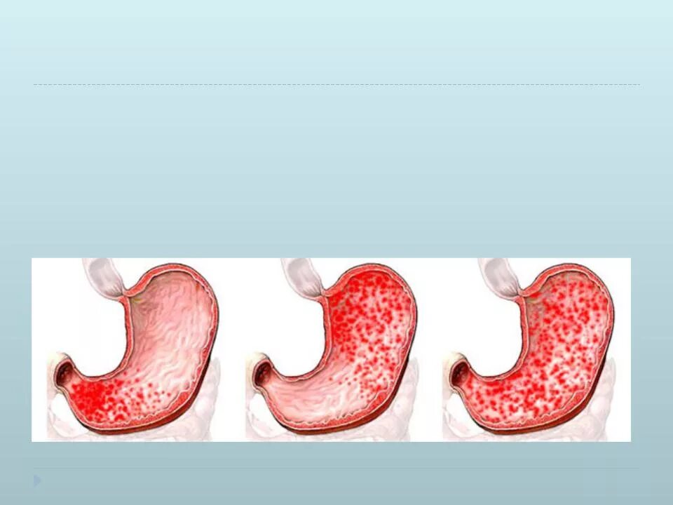 Эритематозный антральный гастрит. Хронич антральный гастрит. Антральный и фундальный гастрит. Атрофический антральный гастрит. Диффузный антральный