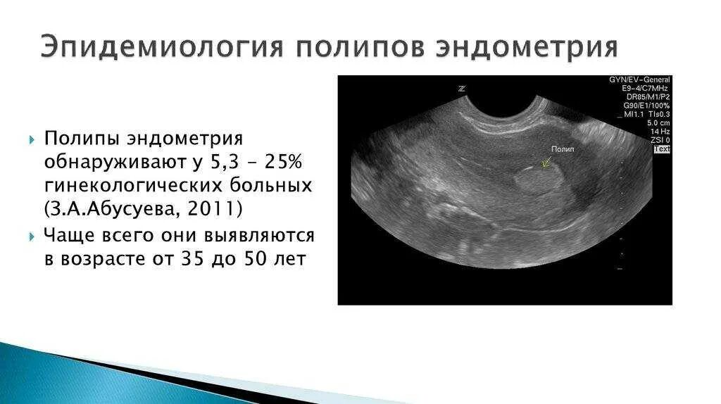 Удаление полипа в матке послеоперационный. Полип в матке на УЗИ Размеры. Железисто фиброзный полип на УЗИ. Железистый полип эндометрия на УЗИ.