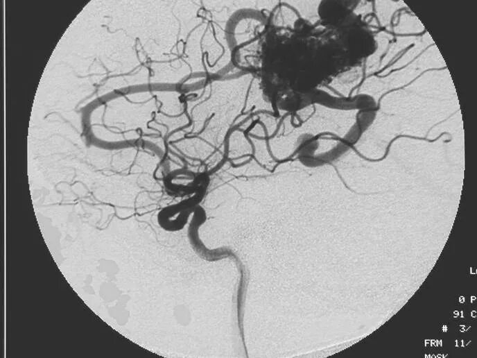Сосудистая аномалия. Сосудистая мальформация головного мозга на кт. Артериовенозная мальформация ангиография. Глому венозная мальформация. Мальформация сосудов мрт.