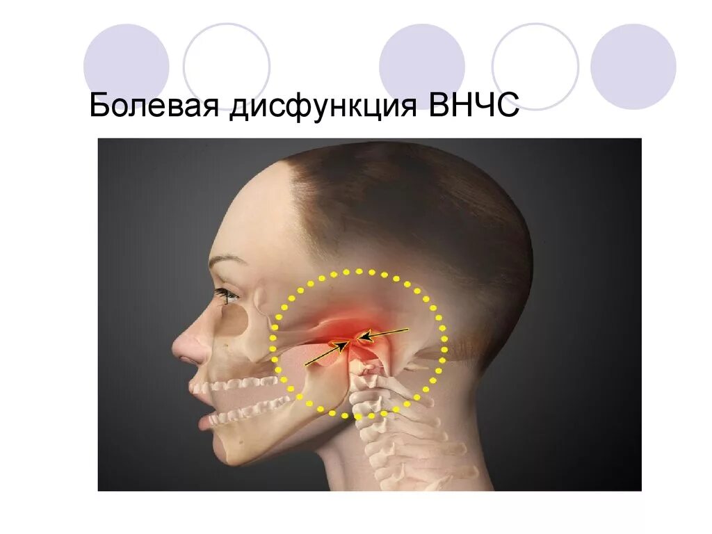 Синдром дисфункции височно-нижнечелюстного сустава. Синдром болевой дисфункции ВНЧС. Синдром болевой дисфункции височно-нижнечелюстного сустава. Лицевой артрит