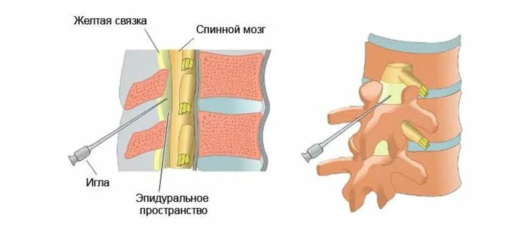 Блокада грыжи поясничного крестцового отдела позвоночника. Эпидуральная игла. эпидуральное пространство спинного мозга. эпидуральная блокада поясничного отдела позвоночника при грыже. эпидуральная анестезия поясничного отдела.