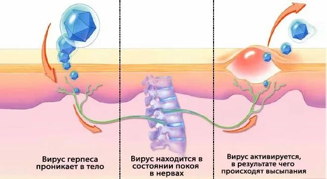Этапы герпеса. Вирус генитального герпеса. герпес стадии развития. герпесвирусная инфекция на губах.