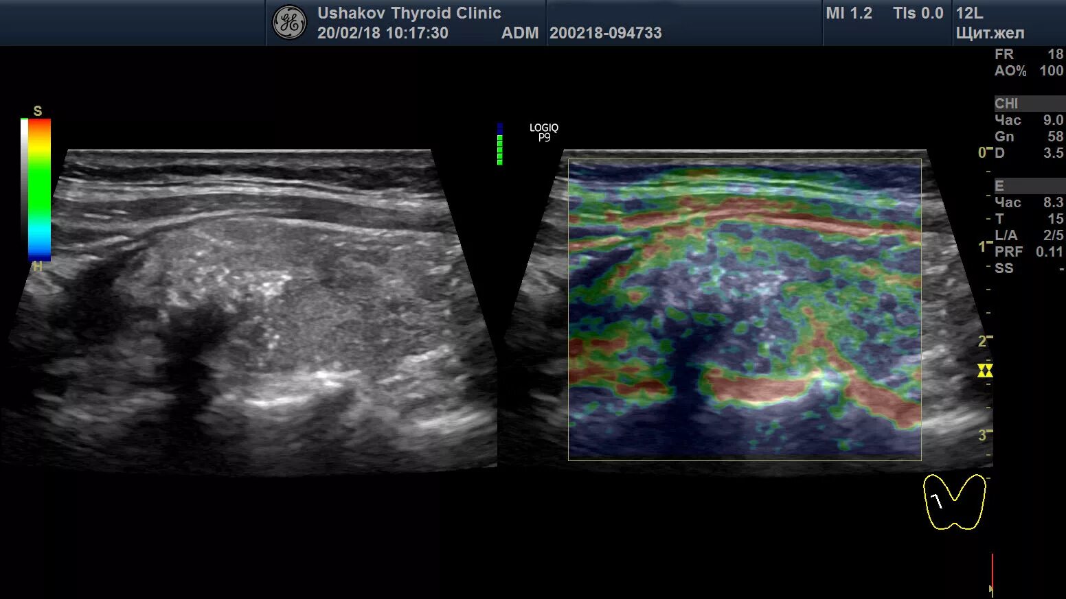 Эластография щитовидной железы что это. Микрокальцинаты в щитовидной железе на УЗИ. Микрокальцинаты узла щитовидной железы на УЗИ. Кальцинаты в щитовидной железе на УЗИ что это такое. Сдвиговая эластография щитовидной железы.