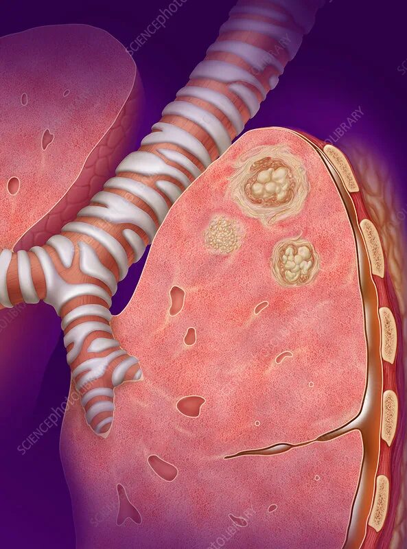 Туберкулез tuberculosis. Казеозная пневмония снимки.