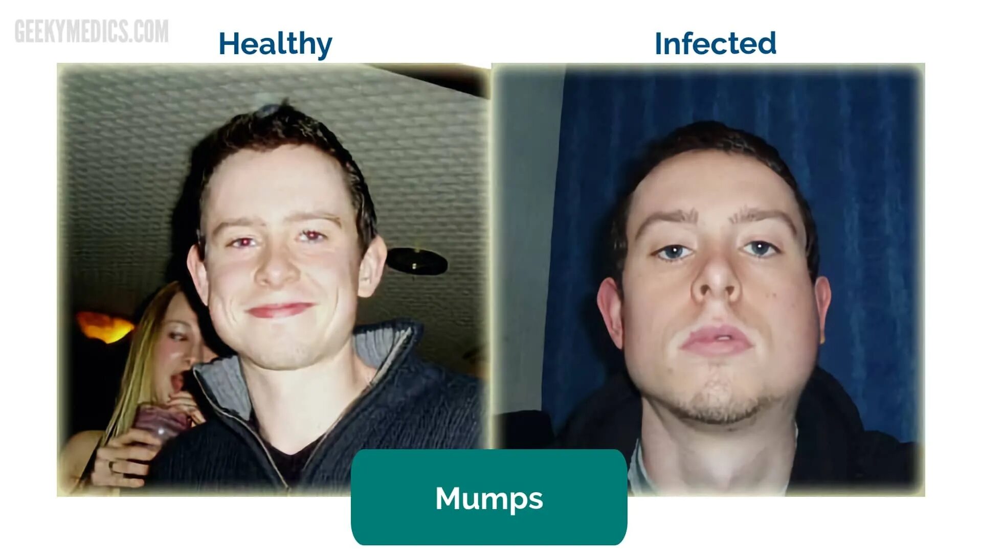 болезнь свинка паротит симптомы. эпидемический паротит. свинка симптомы у взрослых мужчин фото. эпидемический паротит. свинка симптомы у взрослых мужчин фото.